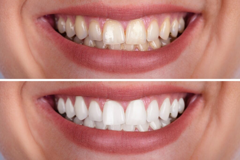 A before and after photo of a woman who has had professional teeth whitening